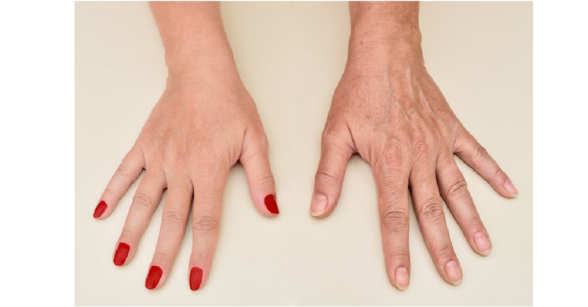 درمان پیری و چروک پوست دست