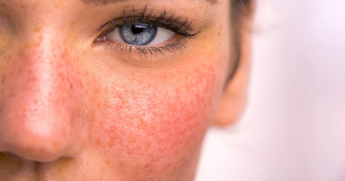 دلیل پوست حساس چیست؟