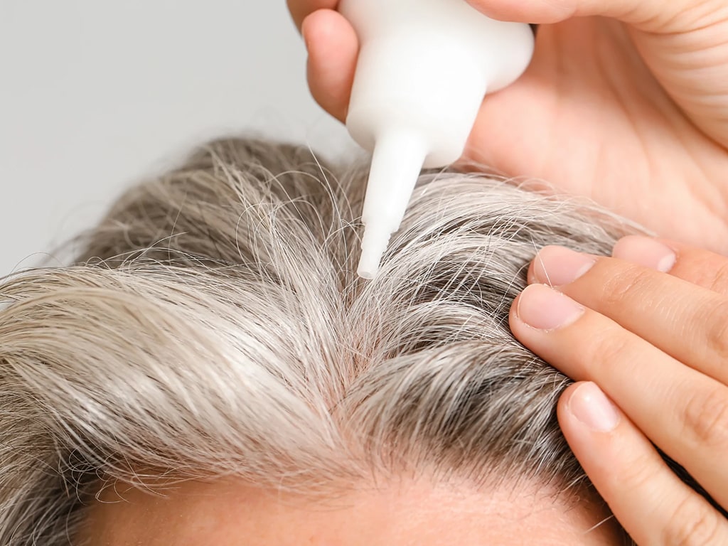  کتوکونازول درمان ریزش مو 