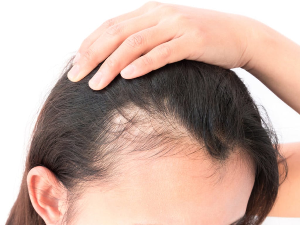 هورمون درمانی درمان ریزش مو 