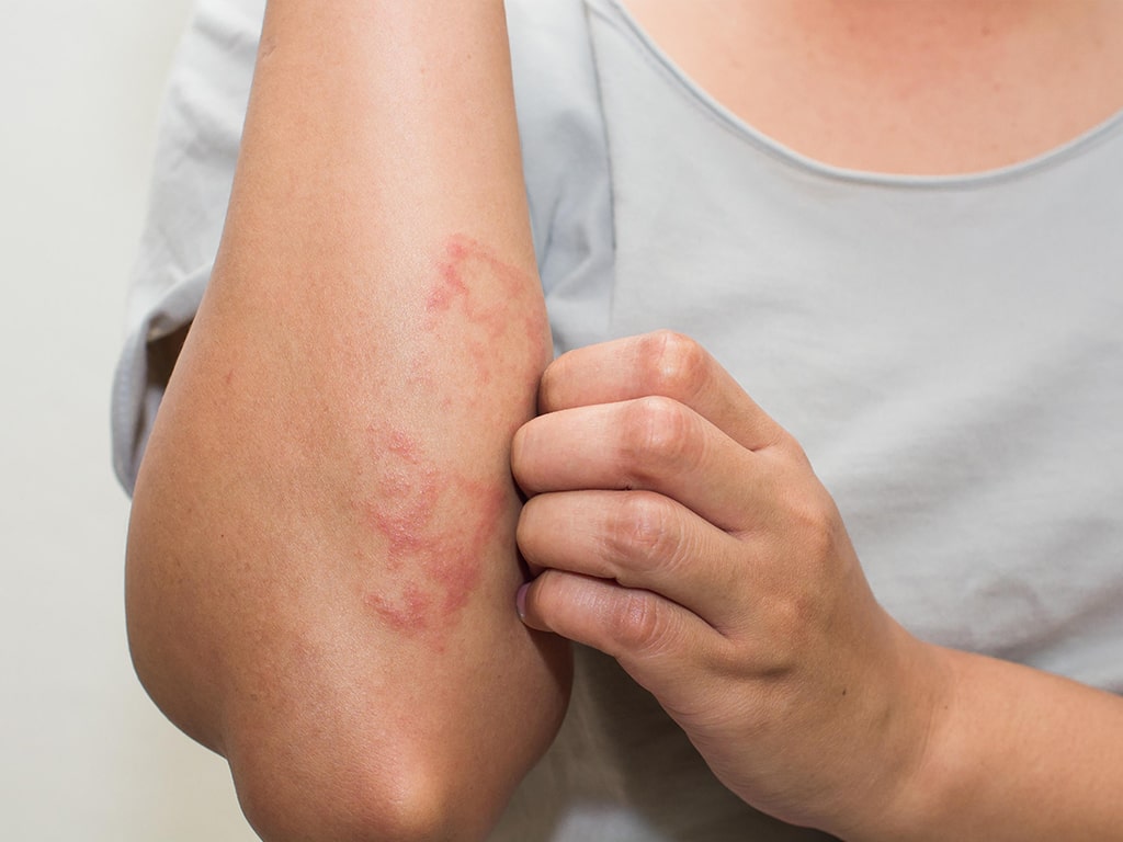 حساسیت‌های پوستی از جمله مشکلاتی است که افراد زیادی با آن درگیر هستند.