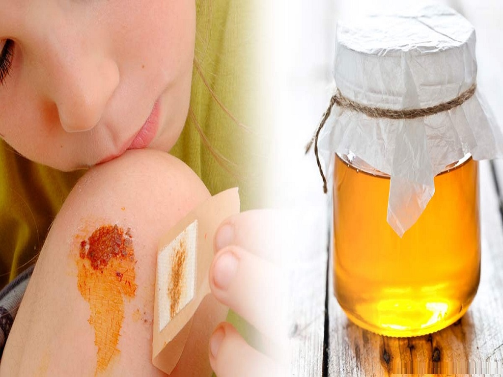 درمان جای سوختگی با عسل