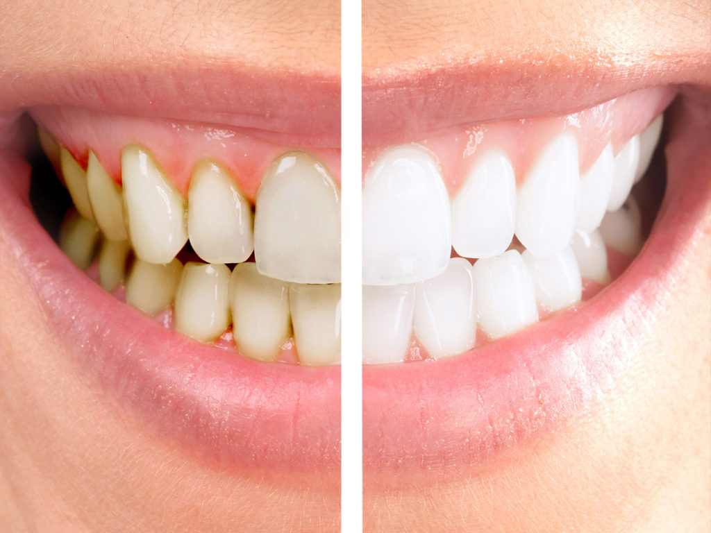 لمینت دندان باعث سلامت و زیبایی دهان و دندان می‌شود.