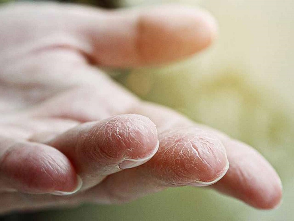 عوامل خشکی پوست دست