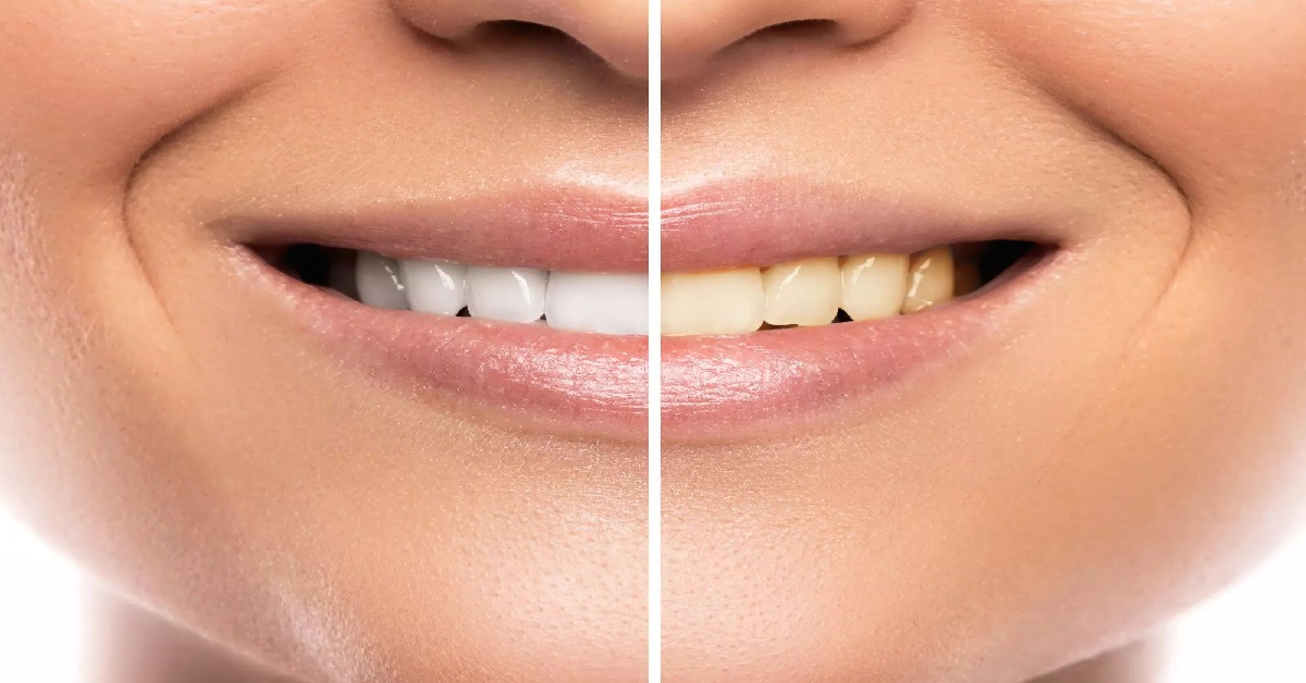 از بین رفتن سفیدی دندان به دلیل عوامل اکتسابی