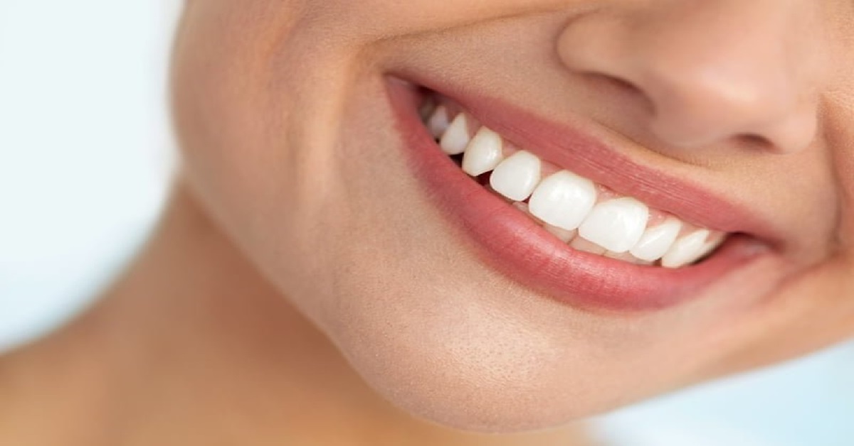 سفید کردن دندان با روش باندینگ دندان