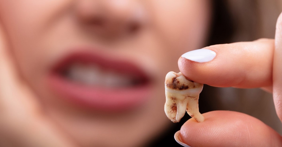 روش‌های درمان پوسیدگی دندان در طب سنتی