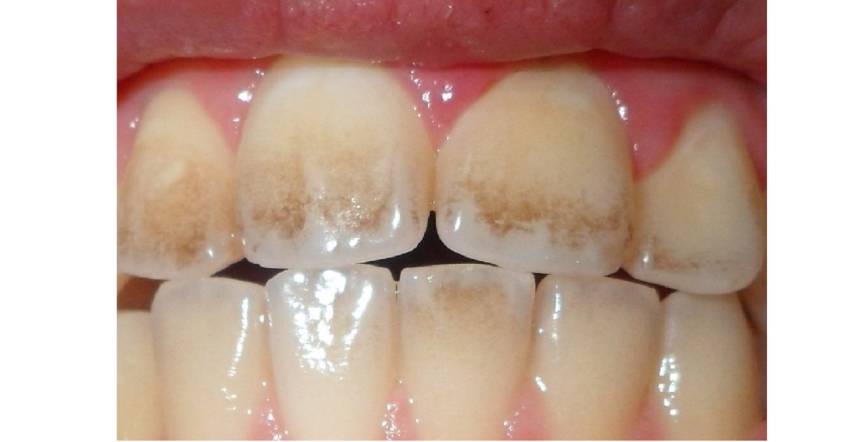 اولین علائم پوسیدگی دندان، ایجاد لکه سفید و گچی روی سطح آن است