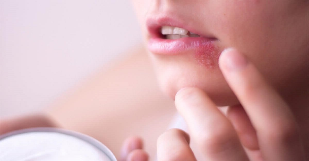 استفاده از کرم‌ها و پمادهای موضعی یکی از بهترین راه های درمان تبخال دهان