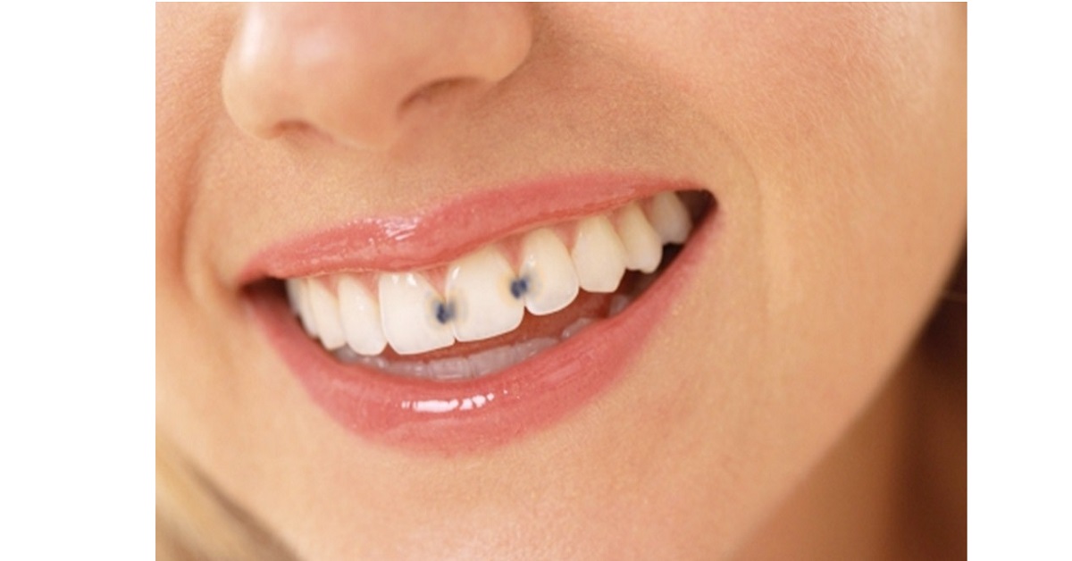 علل بروز پوسیدگی دندان