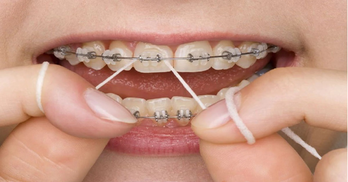 نحوه صحیح نخ دندان کشیدن در ارتودنسی