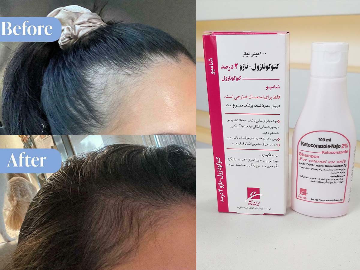 cetoconazol shampoo 1 - شامپو کتوکونازول برای ریزش مو حقیقت یا تبلیغ؟