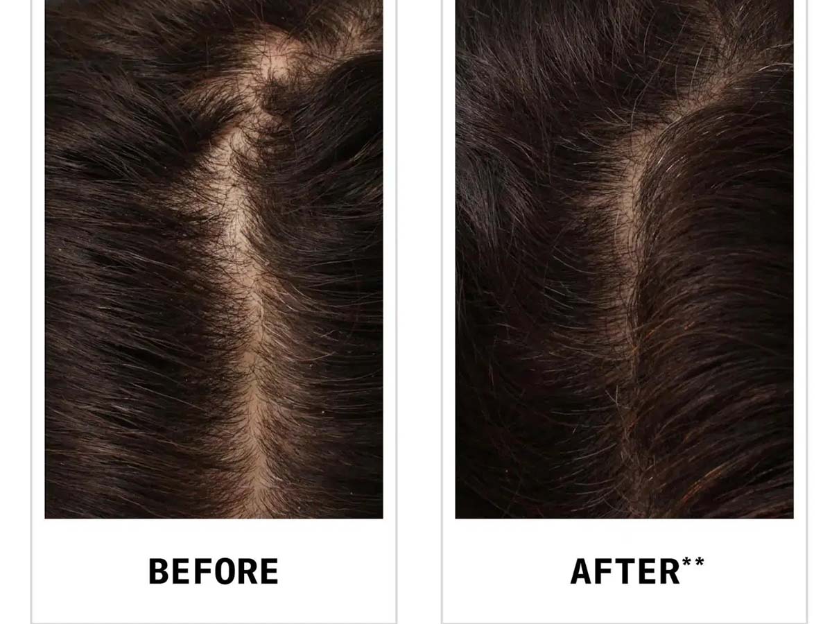 cetoconazol shampoo 4 - شامپو کتوکونازول برای ریزش مو حقیقت یا تبلیغ؟